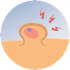 Sebaceous Cyst Teleconsultation